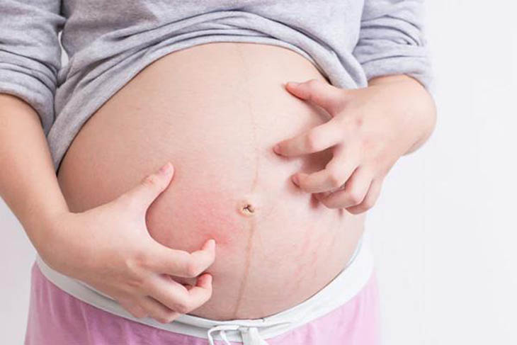 Mẹ bầu cần thận trọng khi chữa nổi mề đay khi mang thai