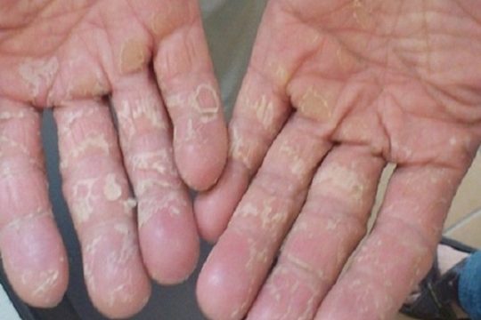 TOP 12 Cách trị chàm theo dân gian tại nhà mang lại hiệu quả bất ngờ 10 cach tri benh cham 4