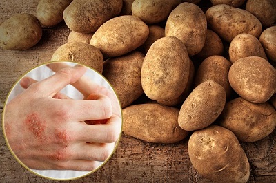 Vì sao lại chọn cách chữa chàm bằng khoai tây?