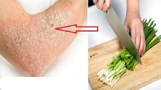 Hướng dẫn 4 cách chữa chàm bằng hành hoa cực tốt chuyên gia khuyên dùng 9 Bài thuốc chữa chàm bằng hành hoa