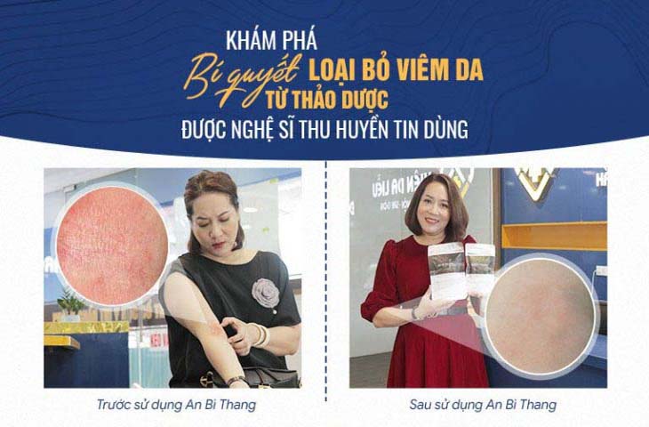 Hình ảnh trước và điều trị viêm da với bài thuốc An Bì Thang của nghệ sĩ Thu Huyền