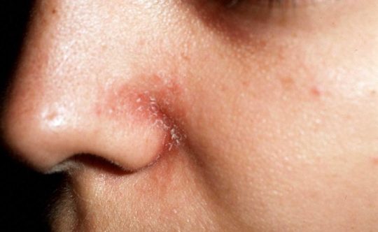 Bệnh viêm da tiết bã có lây không? Cách ngừa lan rộng hiệu quả 5 Bệnh Viêm Da Tiết Bã Có Lây Không? Cách Phòng Tránh Hiệu Quả