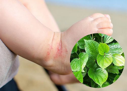 Hướng dẫn chữa viêm da cơ địa bằng lá lốt hiệu quả 4 Tìm hiểu phương pháp chữa viêm da cơ địa bằng lá lốt
