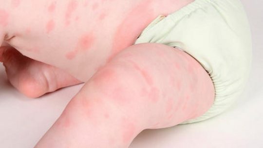 TOP 13 cách chữa viêm da dị ứng bằng lá cây hiệu quả ít người biết 11 Chữa Viêm Da Dị Ứng Bằng Lá Cây Theo Đông Y Hiệu Quả