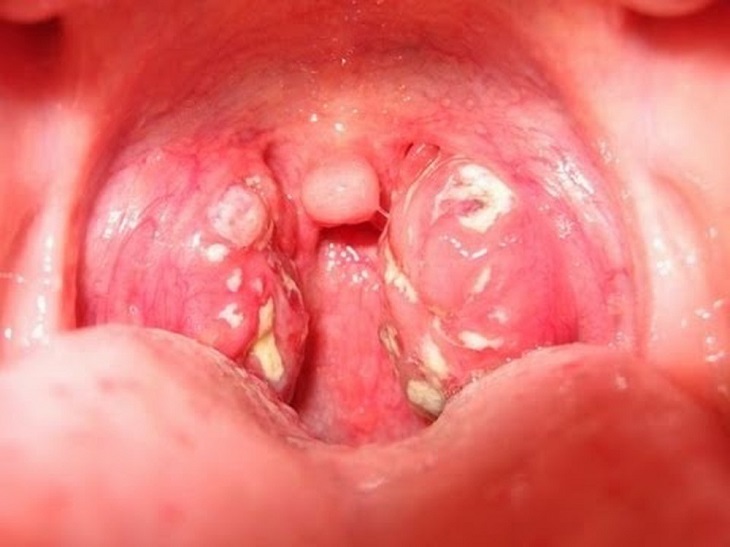 Bệnh viêm họng là gì? Hình ảnh viêm họng. 