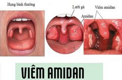 Viêm amidan là bệnh tai mũi họng thường gặp
