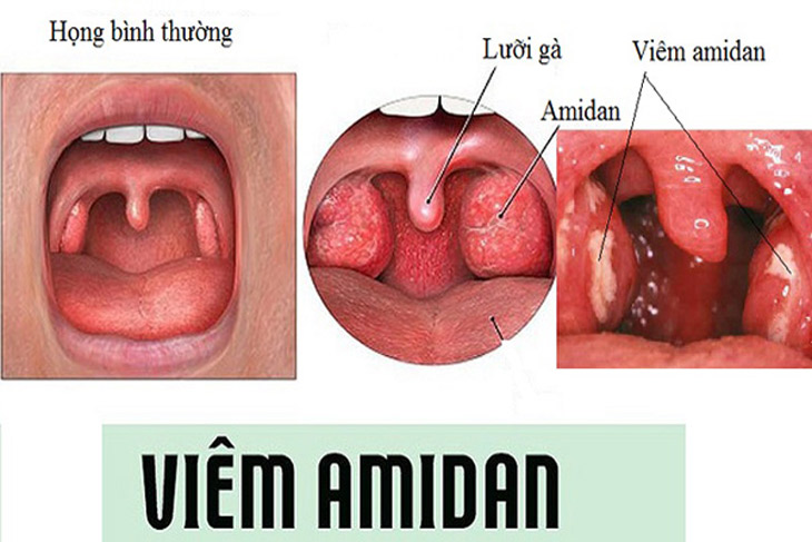 Viêm amidan là bệnh tai mũi họng thường gặp