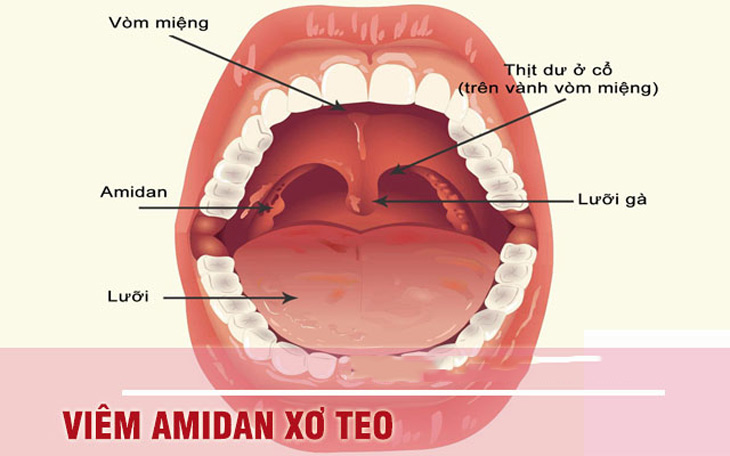 Hình ảnh bệnh viên amidan xơ teo