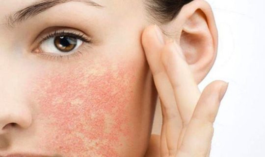 Viêm da dị ứng ở mặt: Nguyên nhân & cách điều trị hiệu quả 3 Viêm Da Dị ứng Ở Mặt: Nguyên Nhân, Hướng Điều Trị