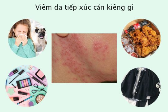 Viêm da tiếp xúc cần kiêng gì để tránh bệnh nặng hơn? 1 Viêm da tiếp xúc cần kiêng gì để có thể khỏi bệnh nhanh chóng