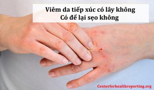 Viêm da tiếp xúc có lây không? Có để lại sẹo không? 7 Nhiều người băn khoăn viêm da tiếp xúc có lây không, có để lại sẹo không?