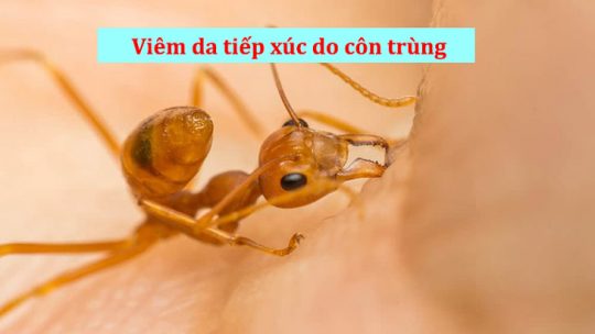 Viêm da tiếp xúc côn trùng là bệnh lý thường gặp