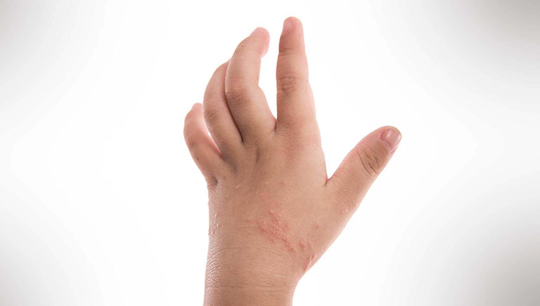 Những trẻ lớn thường bị viêm da tiếp xúc ở bàn tay