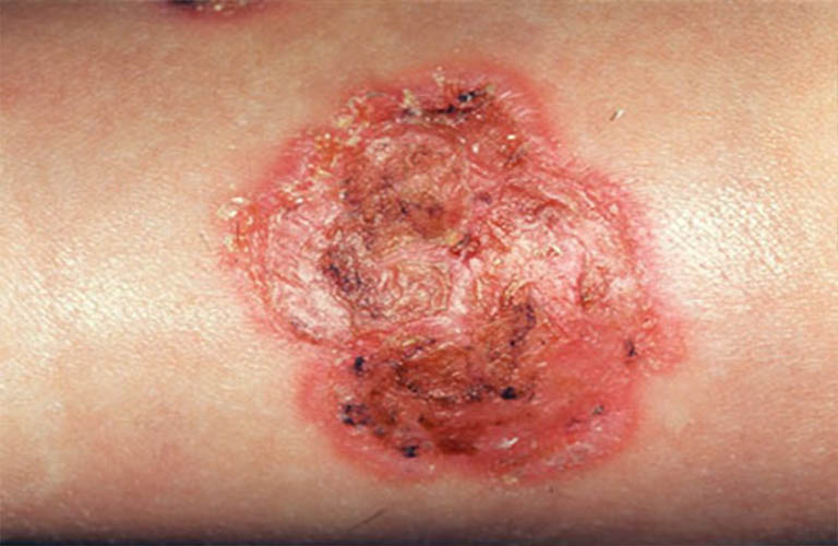 Viêm da tiếp xúc bội nhiễm khiến việc điều trị khó khăn hơn
