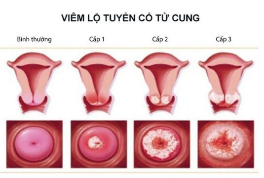 Viêm lộ tuyến 1cm nặng hay nhẹ, có nguy hiểm không