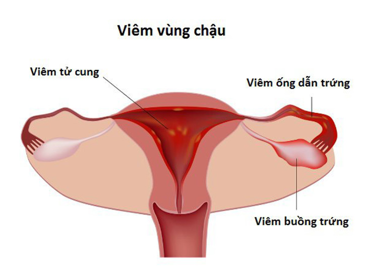 Viêm vùng chậu là tình trạng viêm nhiễm tại các bộ phận ở cơ quan sinh dục