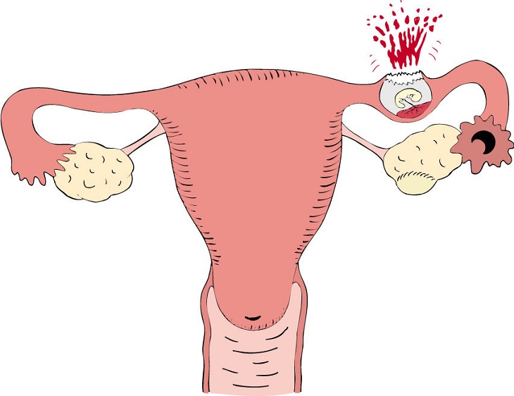 Bị viêm lộ tuyến có thai được không - Làm tăng nguy cơ mang thai ngoài tử cung