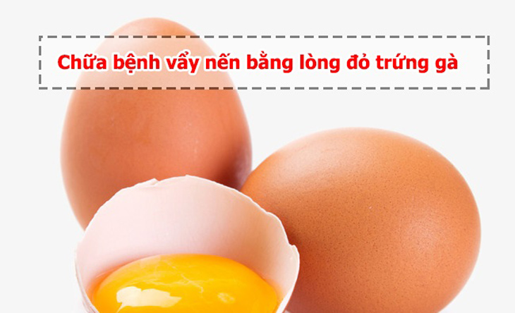 Cách chữa vẩy nến bằng lòng đỏ trứng gà là phương pháp trị bệnh an toàn hiện nay