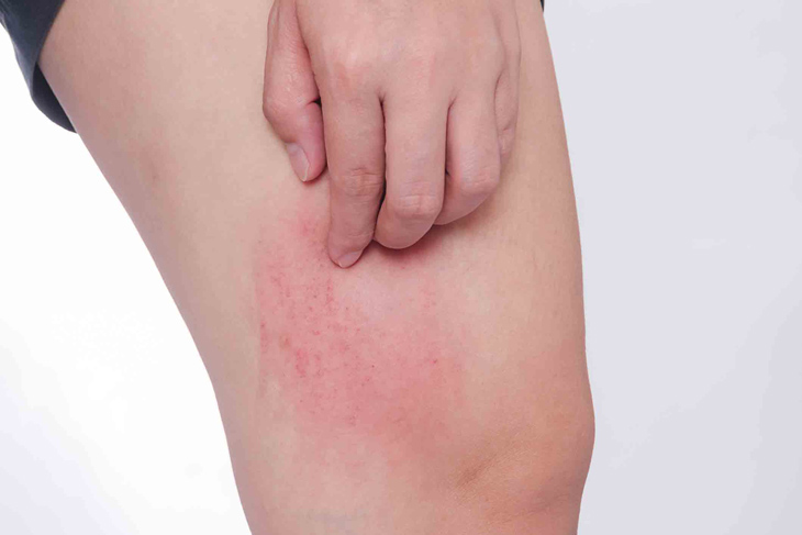 Hạn chế gãi ngứa khi bị mề đay để tránh trầy xước, tổn thương da