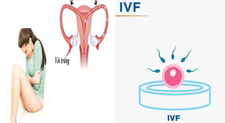 Tắc vòi trứng có làm IVF được không là thắc mắc của hầu hết người bệnh