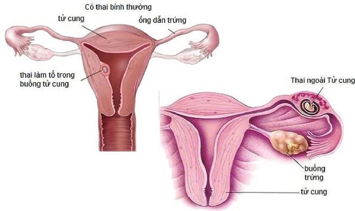 Biến chứng nguy hiểm của tắc vòi trứng là có thai ngoài tử cung