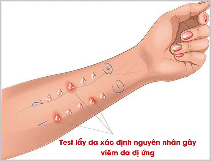 Test lẩy da xác định nguyên nhân gây viêm da dị ứng