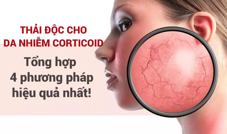 Thải độc da nhiễm corticoid