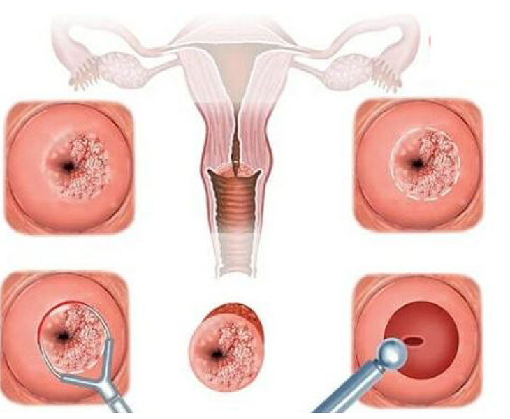 Viêm lộ tuyến cổ tử cung là căn bệnh phổ biến ở phụ nữ trong độ tuổi sinh nở