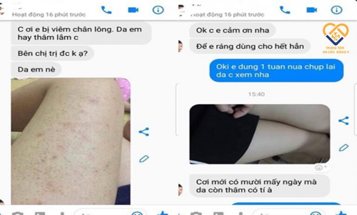 Phản hồi của bệnh nhân Nguyễn Thủy Tiên về hiệu quả điều trị viêm nang lông với An Bì Thang