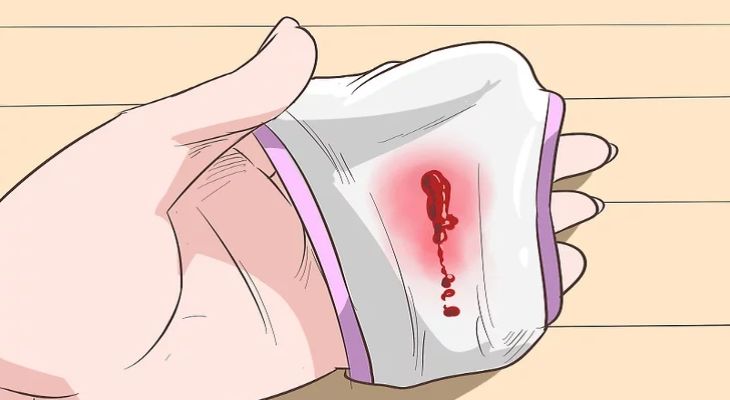 Viêm cổ tử cung cấp độ 2 có thể gây chảy máu vùng kín
