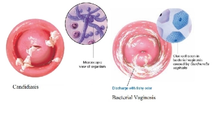 Viêm âm đạo do gardnerella vaginalis nguy hiểm ở chị em phụ nữ