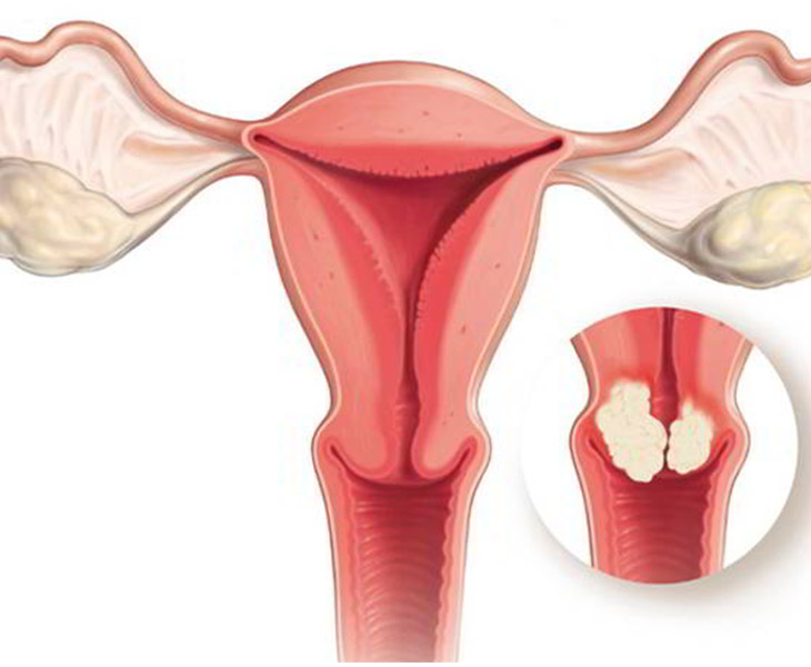 Viêm nội mạc cổ tử cung có biểu hiện chảy mủ âm đạo