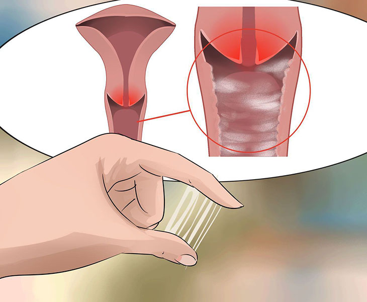 Hiện tượng âm đạo ra mủ cảnh báo giai đoạn nguy hiểm của một số căn bệnh phụ khoa ở phụ nữ