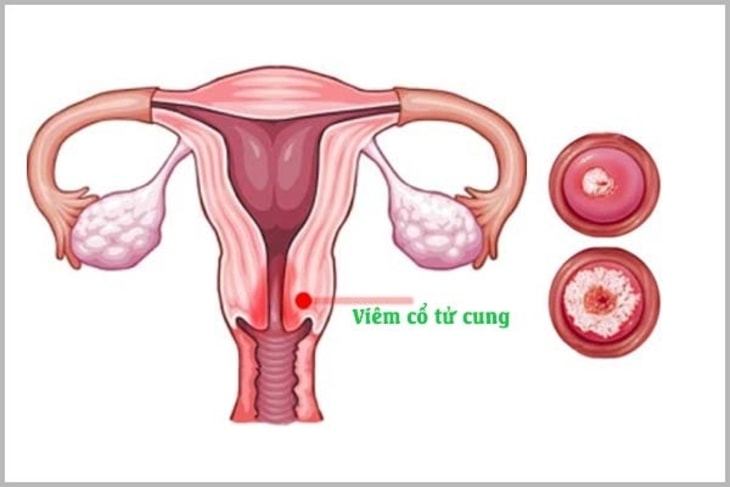 Hình ảnh viêm cổ tử cung ở phụ nữ
