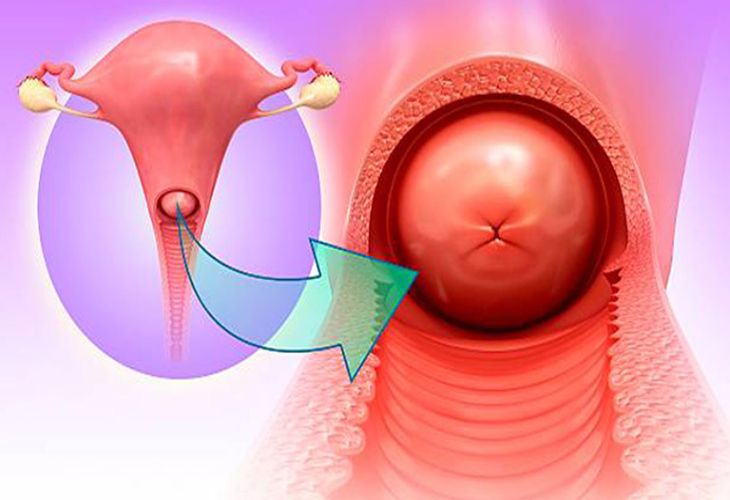 Viêm cổ tử cung có nguy hiểm không là thắc măc của nhiều người bệnh