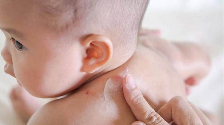 Trẻ sơ sinh, trẻ em là đối tượng dễ bị viêm da dị ứng