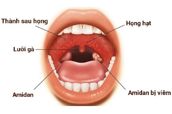Viêm họng hạt là một căn bệnh thường gặp có thể điều trị dứt điểm