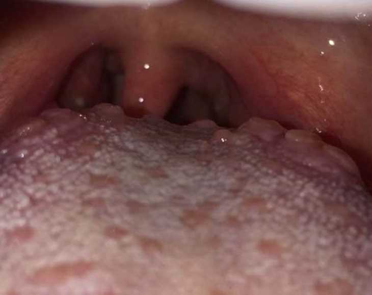 Hình ảnh viêm họng hạt ở lưỡi