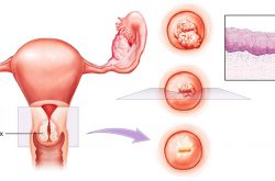 Viêm lộ tuyến tái tạo cổ tử cung là gì? Hình ảnh mô tả