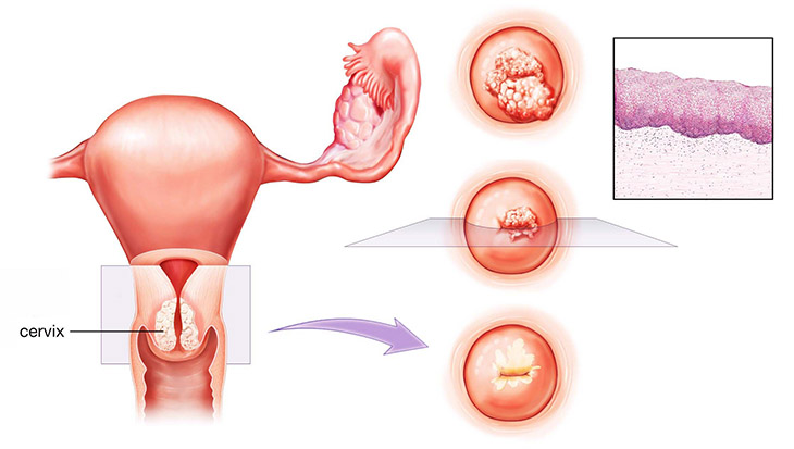 Viêm lộ tuyến tái tạo cổ tử cung là gì? Hình ảnh mô tả
