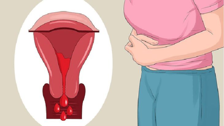 U lạc nội mạc tử cung khiến chu kỳ máu kinh dài hơn và tăng nguy cơ vô sinh ở nữ giới