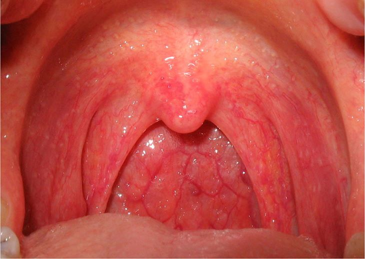 Cefuroxim có thể dùng để điều trị viêm họng do nhiễm vi khuẩn nhạy cảm