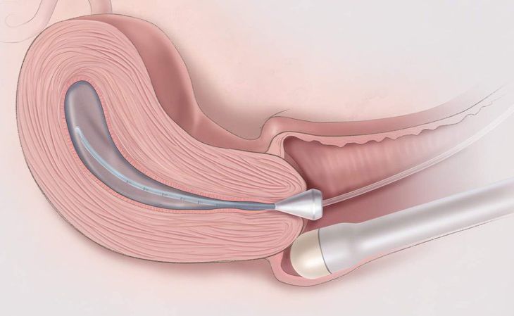 Siêu âm tử cung giúp chẩn đoán lạc nội mạc tử cung vết mổ đẻ