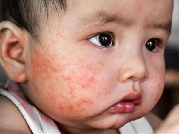 Trẻ bị chàm sữa cấp tính có thể bị nổi mẩn đỏ trên mặt