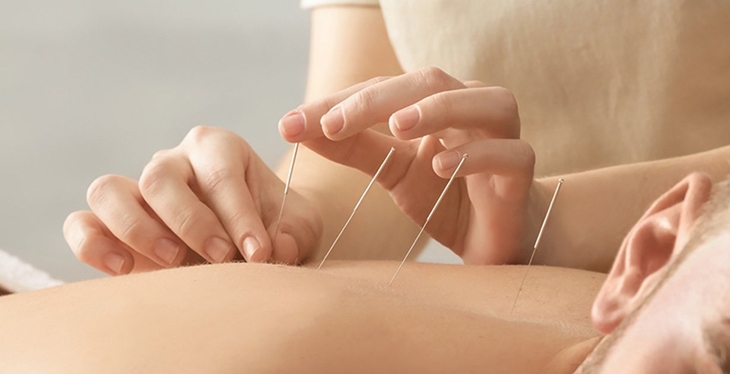 Châm cứu, bấm huyệt cũng là cách chữa rối loạn cương dương bằng Đông y cho hiệu quả tích cực