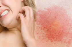 Nguyên nhân và biện pháp khắc phục da bị đỏ rát và ngứa