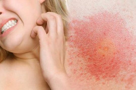 Nguyên nhân và biện pháp khắc phục da bị đỏ rát và ngứa