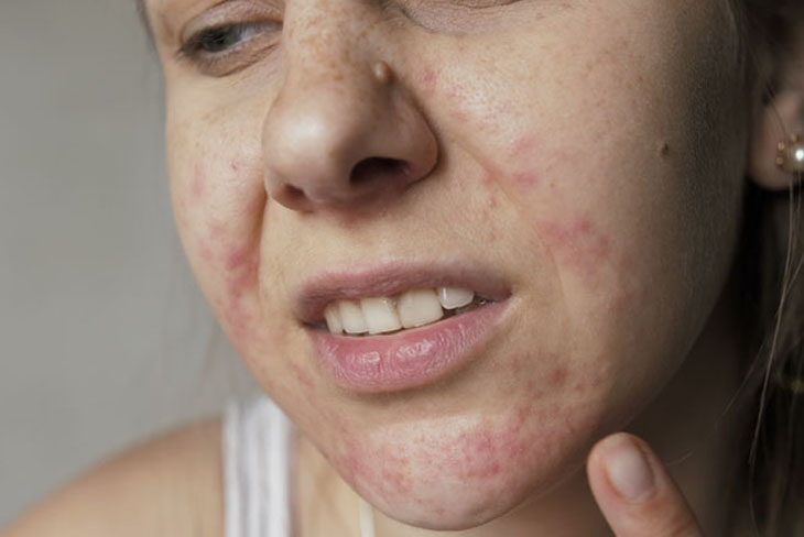 Ảnh hưởng của một số bệnh lý trong cơ thể cũng có thể khiến da nổi mẩn đỏ, ngứa rát.