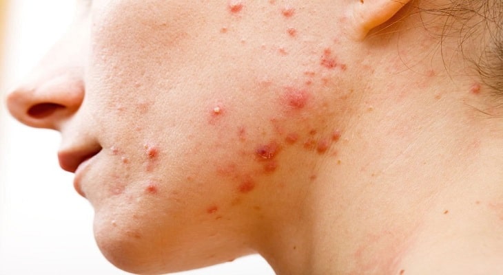 Khi bị ngứa da mặt có thể là do bệnh viêm da