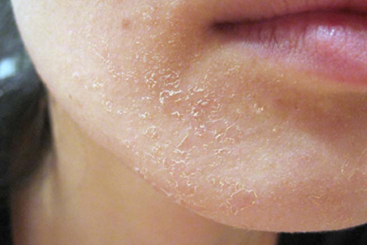 Nguyên nhân và mẹo xử lý da mặt ngứa và khô nhanh chóng